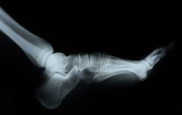 Unhealthy-ankle-NF-Podiatry Unhealthy-ankle-NF-Podiatry