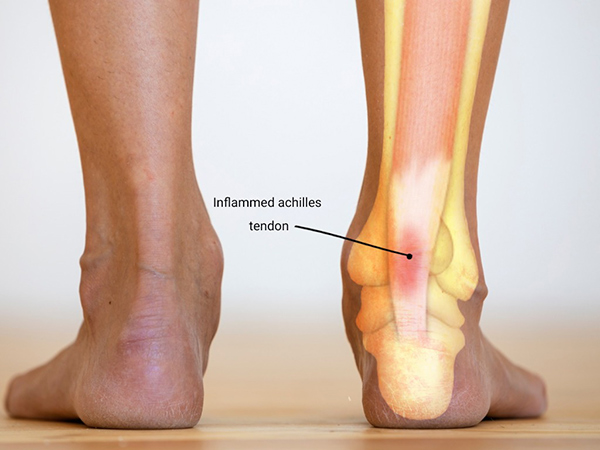 Achilles-tendon-NF-Podiatry