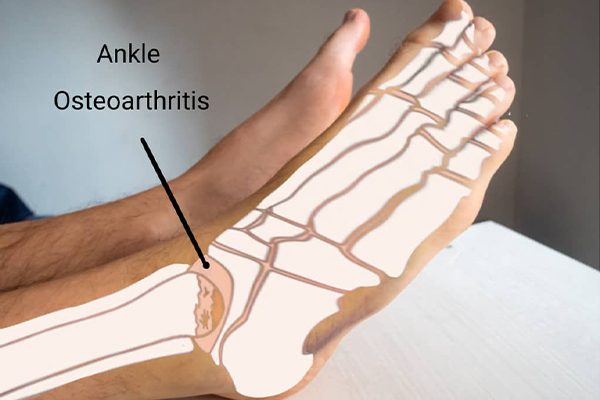 Ankle-Osteoarthritis-NF-Podiatry Ankle-Osteoarthritis-NF-Podiatry