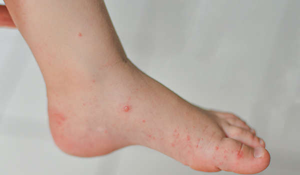 Skin-and-soft-tissues-NF-Podiatry