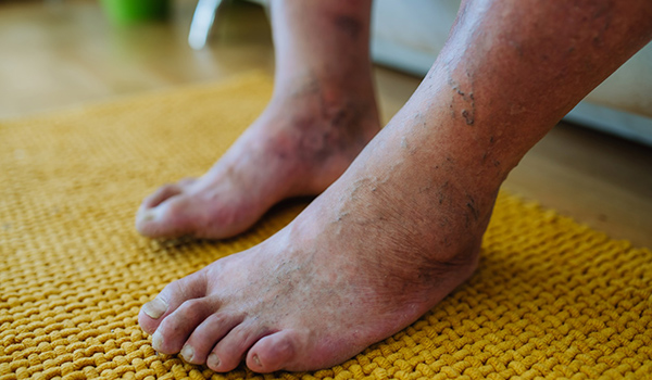 Swollen-feet-NF-Podiatry