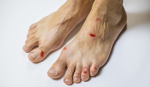 Wounds-ulcer-NF-Podiatry