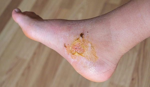 burst-wound-NF-Podiatry burst-wound-NF-Podiatry