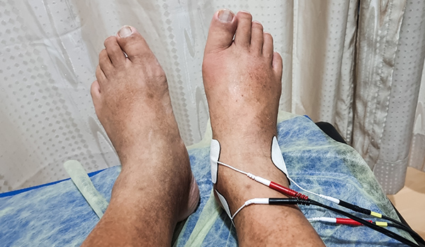 check-up-for-charcot-foot-NF-Podiatry check-up-for-charcot-foot-NF-Podiatry