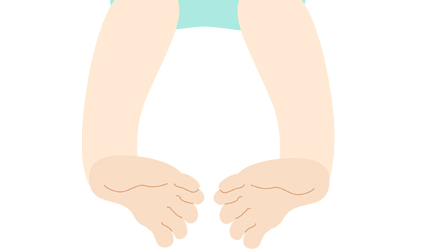 club-foot-illust-NF-Podiatry club-foot-illust-NF-Podiatry