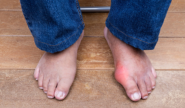 man-with-swollen-deformed-inflammed-toe-joint-NF-Podiatry man-with-swollen-deformed-inflammed-toe-joint-NF-Podiatry