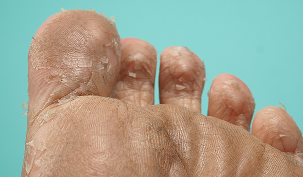 Athlete-feet-dry-flaky-NF-Podiatry Athlete-feet-dry-flaky-NF-Podiatry