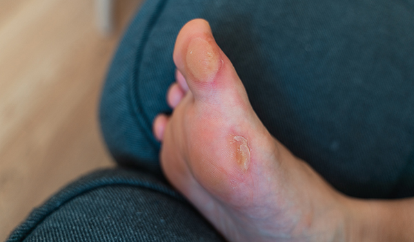 Athlete-foot-NF-Podiatry Athlete-foot-NF-Podiatry