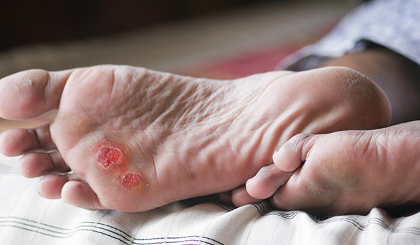 Diabetic-Ulcer-NF-Podiatry Diabetic-Ulcer-NF-Podiatry