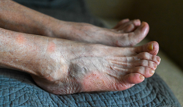 Diabetic-feet-NF-Podiatry Diabetic-feet-NF-Podiatry